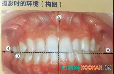 拍不好口腔照片怎么辦？這些口腔攝影方法與技巧請(qǐng)收好！